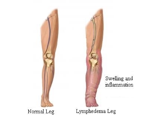 normal leg versus leg with Lymphedema